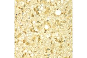 Immunohistochemistry of paraffin-embedded human brain cancer using SPAG16 antibody at dilution of 1:100 (x400 lens).