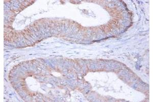 Immunohistochemistry of paraffin-embedded human colon cancer using ABIN7149114 at dilution of 1:100 (UQCRFS1 antibody  (AA 79-274))