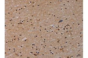 The image on the left is immunohistochemistry of paraffin-embedded Human brain tissue using ABIN7191791(PARP8 Antibody) at dilution 1/40, on the right is treated with synthetic peptide. (PARP8 antibody)