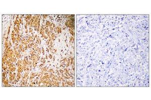 Immunohistochemistry analysis of paraffin-embedded human breast carcinoma tissue, using ZSCAN22 antibody. (ZSCAN22 antibody  (Internal Region))