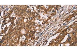 Immunohistochemistry of paraffin-embedded Human gasrtic cancer tissue using DICER1 Polyclonal Antibody at dilution 1:40 (DICER1 antibody)