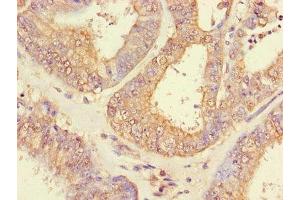 Immunohistochemistry of paraffin-embedded human endometrial cancer using ABIN7151005 at dilution of 1:100 (CHFR antibody  (AA 141-422))