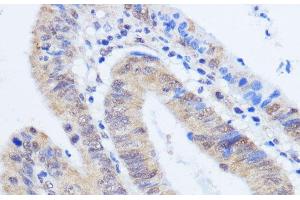 Immunohistochemistry of paraffin-embedded Human colon carcinoma using RBM39 Polyclonal Antibody at dilution of 1:100 (40x lens). (RBM39 antibody)