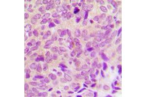 Immunohistochemical analysis of PTP1B staining in human breast cancer formalin fixed paraffin embedded tissue section. (PTPN1 antibody  (N-Term))