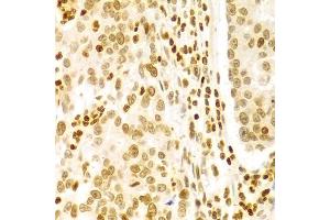 Immunohistochemistry of paraffin-embedded human gastric cancer using DKC1 Antibody (ABIN5970956) at dilution of 1/100 (40x lens). (DKC1 antibody)