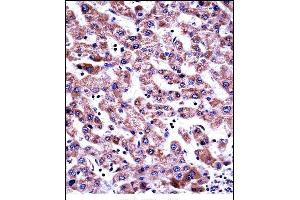 GDI2 Antibody (Center) ((ABIN657709 and ABIN2846700))immunohistochemistry analysis in formalin fixed and paraffin embedded human liver tissue followed by peroxidase conjugation of the secondary antibody and DAB staining. (GDI2 antibody  (AA 135-164))