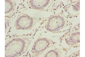 Immunohistochemistry of paraffin-embedded human colon cancer using ABIN7167697 at dilution of 1:100 (RPA2 antibody  (AA 1-267))