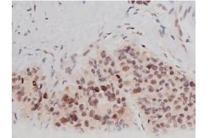 ABIN6267361 at 1/200 staining Human liver cancer tissue sections by IHC-P.