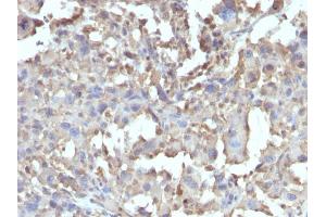 Formalin-fixed, paraffin-embedded human Histiocytoma stained with TNF alpha Rabbit Recombinant Monoclonal Antibody (TNF/1500R).