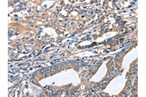 The image on the left is immunohistochemistry of paraffin-embedded Human gastric cancer tissue using ABIN7128332(AKR1D1 Antibody) at dilution 1/35, on the right is treated with fusion protein. (AKR1D1 antibody)