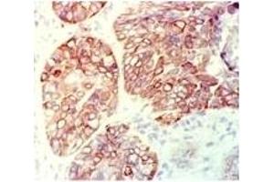 RCK102 Cytokeratin staining of a human squamous cell carcinoma of the lung.