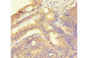 Immunohistochemistry of paraffin-embedded human colon cancer using ABIN7171536 at dilution of 1:100 (TAS2R13 antibody  (AA 150-184))