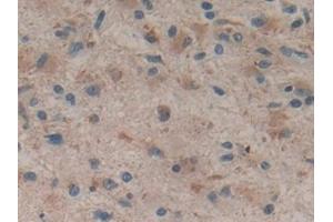 Detection of HMGCS in Human Glioma Tissue using Polyclonal Antibody to Hydroxymethylglutaryl Coenzyme A Synthase (HMGCS)