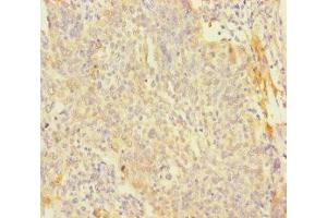 Immunohistochemistry of paraffin-embedded human cervical cancer using ABIN7166699 at dilution of 1:100 (PAGE2B antibody  (AA 1-111))