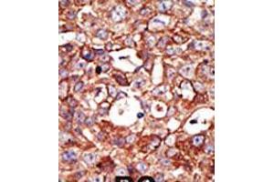 Formalin-fixed and paraffin-embedded human cancer tissue reacted with the primary antibody, which was peroxidase-conjugated to the secondary antibody, followed by DAB staining. (ZMPSTE24 antibody  (AA 400-430))