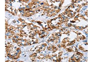 The image on the left is immunohistochemistry of paraffin-embedded Human thyroid cancer tissue using ABIN7129698(HINT2 Antibody) at dilution 1/40, on the right is treated with fusion protein.
