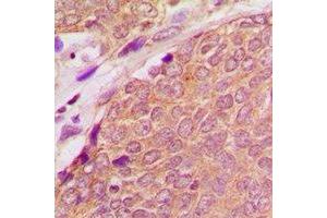 Immunohistochemical analysis of ASC staining in human breast cancer formalin fixed paraffin embedded tissue section. (STS antibody  (N-Term))