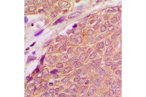 Immunohistochemical analysis of ASC staining in human breast cancer formalin fixed paraffin embedded tissue section. (STS antibody  (N-Term))