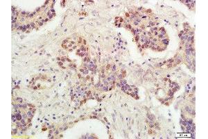 Formalin-fixed and paraffin embedded human ovarian carcinoma labeled with Rabbit Anti-P53 protein(wt-p53) Polyclonal Antibody , Unconjugated 1:300 followed by conjugation to the secondary antibody and DAB staining