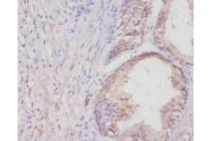 Immunohistochemistry of paraffin-embedded human colon cancer using ABIN7178837 at dilution of 1:20 (COL1A1 antibody  (AA 955-1207))