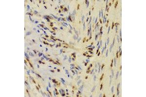 Immunohistochemistry of paraffin-embedded human adenomyosis using XRCC5 Antibody. (XRCC5 antibody  (AA 543-732))