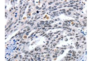 The image on the left is immunohistochemistry of paraffin-embedded Human ovarian cancer tissue using ABIN7191321(LRP5 Antibody) at dilution 1/55, on the right is treated with synthetic peptide. (LRP5 antibody)