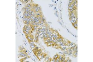 Immunohistochemistry of paraffin-embedded human gastric carcinoma using MBL2 antibody (ABIN6132334, ABIN6143597, ABIN6143600 and ABIN6221519) at dilution of 1:100 (40x lens).