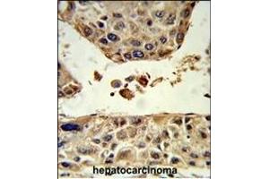 Formalin-fixed and paraffin-embedded human hepatocarcinoma reacted with HPD Antibody (C-term), which was peroxidase-conjugated to the secondary antibody, followed by DAB staining. (HPD antibody  (C-Term))