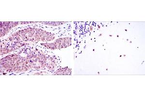 Immunohistochemical analysis of paraffin-embedded ovarian cancer (left) and cerebellum tissues (right) using MSI2 mouse mAb with DAB staining. (MSI2 antibody)