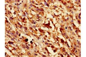Immunohistochemistry of paraffin-embedded human melanoma using ABIN7153440 at dilution of 1:100 (LGALS1/Galectin 1 antibody  (AA 2-135))