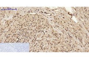 Immunohistochemistry of paraffin-embedded Human uterus cancer tissue using BRCA1 Polyclonal Antibody at dilution of 1:200. (BRCA1 antibody)