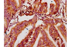 IHC image of ABIN7159553 diluted at 1:400 and staining in paraffin-embedded human endometrial cancer performed on a Leica BondTM system. (MTSS1 antibody  (AA 616-730))