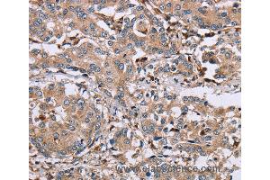 Immunohistochemistry of Human liver cancer using MAGEA3 Polyclonal Antibody at dilution of 1:50