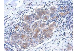 IHC-P Image Immunohistochemical analysis of paraffin-embedded human breast cancer, using SERPINB6 antibody, antibody at 1:500 dilution.