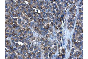 IHC-P Image PEX26 antibody detects PEX26 protein at cytoplasm in human cervical cancer by immunohistochemical analysis. (PEX26 antibody)