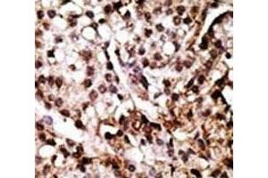 IHC analysis of FFPE human breast carcinoma tissue stained with the ATG7 antibody (ATG7 antibody  (AA 22-51))