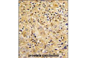 Formalin-fixed and paraffin-embedded human prostate carcinoma reacted with LUM Antibody , which was peroxidase-conjugated to the secondary antibody, followed by DAB staining.