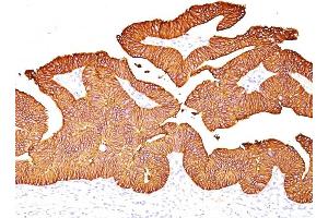 Formalin-fixed, paraffin-embedded human Colon Carcinoma stained with EpCAM Mouse Monoclonal Antibody (EGP40/837). (EpCAM antibody)