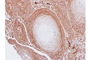 IHC-P Image Immunohistochemical analysis of paraffin-embedded Cal27 xenograft, using BAG3, antibody at 1:100 dilution. (BAG3 antibody  (C-Term))