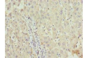 Immunohistochemistry of paraffin-embedded human liver cancer using ABIN7176188 at dilution of 1:100 (ZNF253 antibody  (AA 80-300))