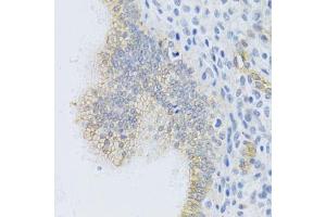 Immunohistochemistry of paraffin-embedded human uterine cancer using ABCC1 Antibody.