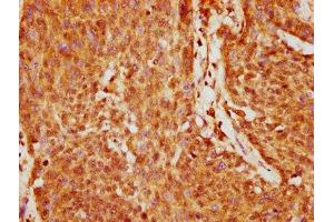 IHC image of ABIN7153409 diluted at 1:200 and staining in paraffin-embedded human cervical cancer performed on a Leica BondTM system.