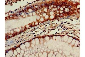 Immunohistochemistry of paraffin-embedded human colon cancer using ABIN7154664 at dilution of 1:100 (GNGT1 antibody  (AA 2-65))