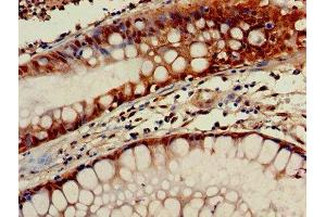 Immunohistochemistry of paraffin-embedded human colon cancer using ABIN7154664 at dilution of 1:100