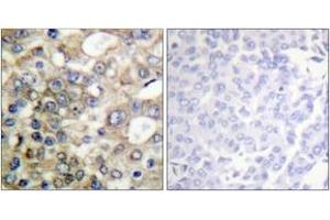 Immunohistochemistry analysis of paraffin-embedded human breast carcinoma, using CD227/MUC1 (Phospho-Tyr1229) Antibody. (MUC1 antibody  (pTyr1229))