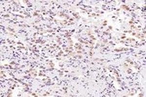 Immunohistochemistry analysis of paraffin-embedded human lung cancer using SRFBP1 (ABIN7075579) at dilution of 1: 2000 (SRFBP1 antibody)