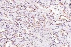 Immunohistochemistry analysis of paraffin-embedded human lung cancer using SRFBP1 (ABIN7075579) at dilution of 1: 2000 (SRFBP1 antibody)