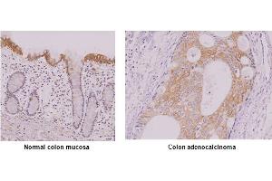 Paraffin embedded sections of normal colon mucosa and colon adenocalcinoma tissue were incubated with anti-human IRF-5 antibody (1:50) for 2 hours at room temperature. (IRF5 antibody)