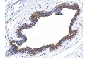 IHC-P Image Immunohistochemical analysis of paraffin-embedded human breast cancer, using MAPK4, antibody at 1:500 dilution. (MAPK4 antibody)