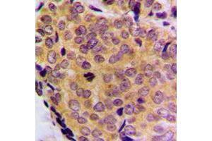 Immunohistochemical analysis of BCLW staining in human breast cancer formalin fixed paraffin embedded tissue section. (BCL2L2 antibody  (C-Term))